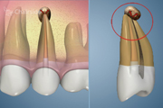 Complication-Additional Canal Missed